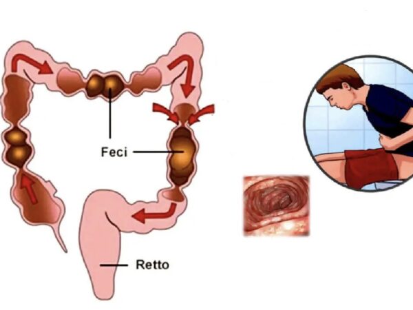 Riflesso gastro-colico
